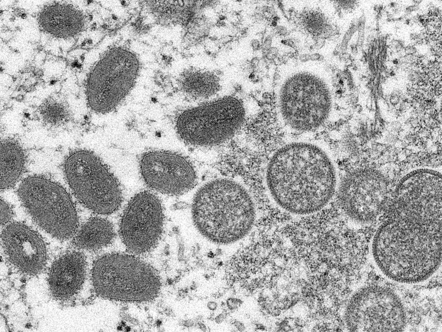 世衛組織：全球報告131例猴痘確診病例、106例疑似病例