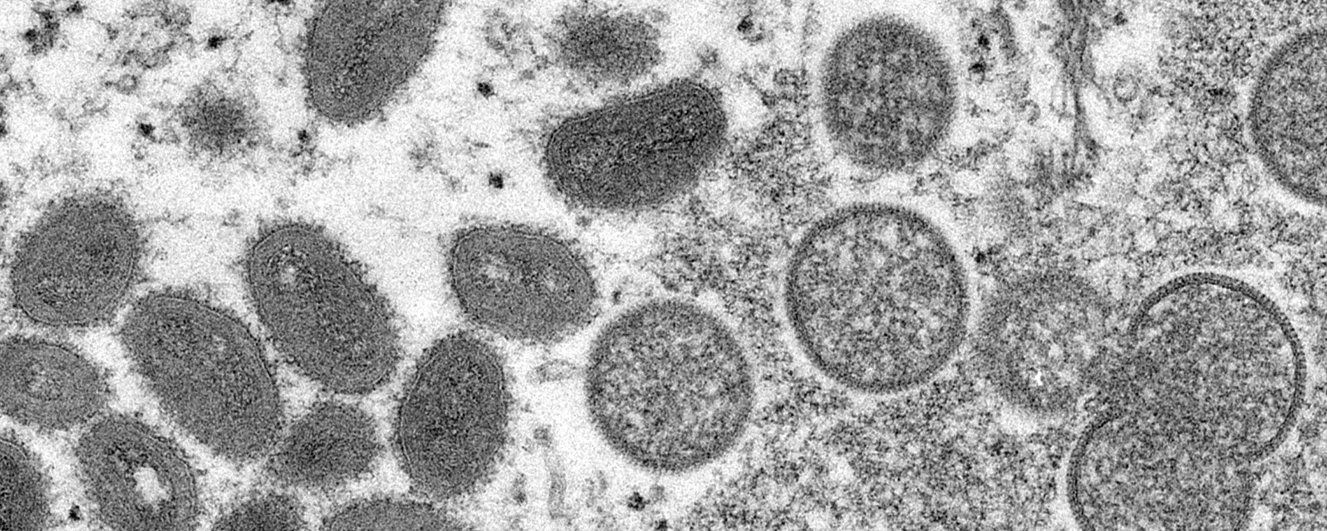 美國又一州因猴痘疫情進入公共衛生緊急狀態