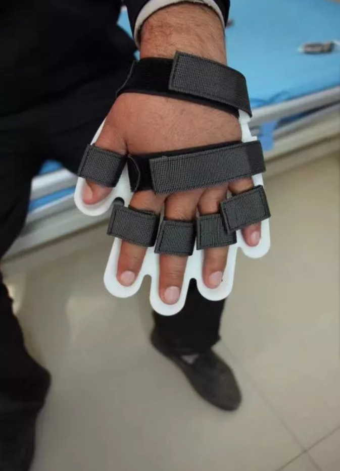 先临三维云打印3d打印技术助中风患者手功能康复