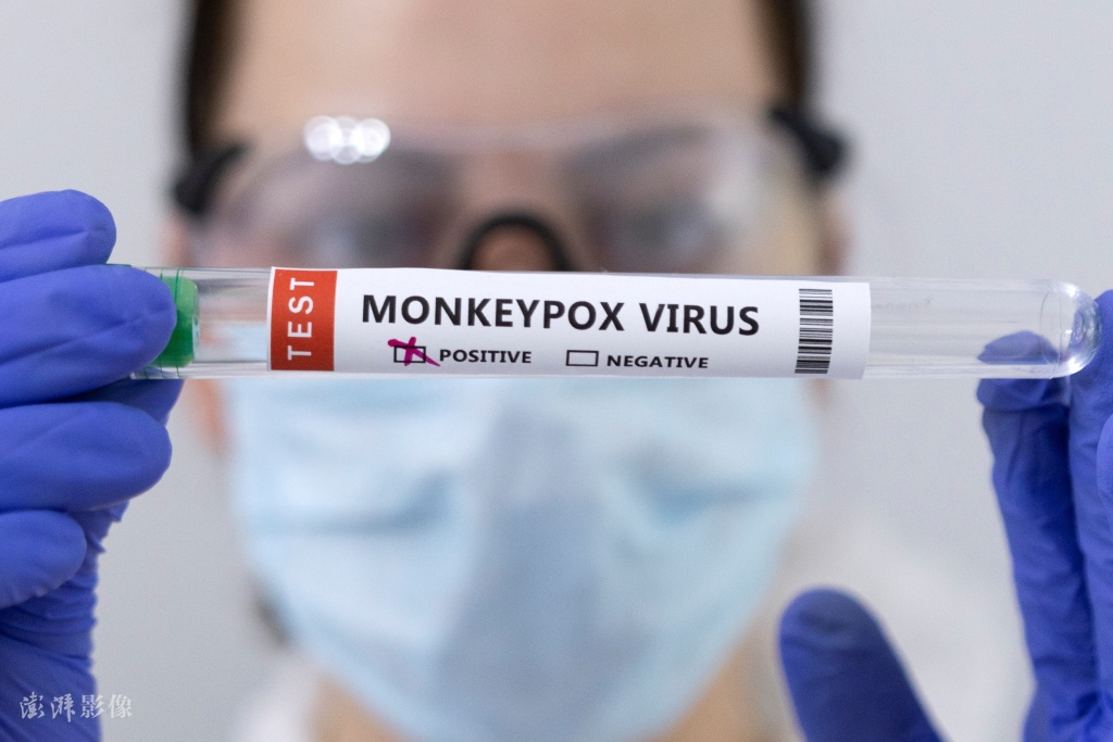 英國發現猴痘病毒新毒株 患者近期去過非洲